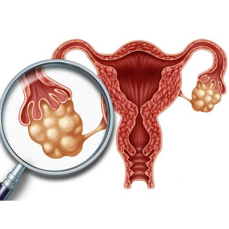 Fibroid / PCOD