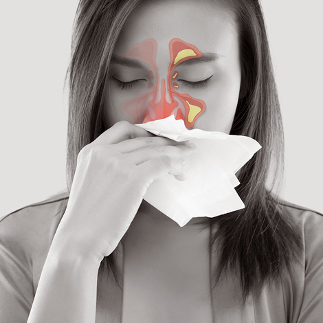 Sinusitis